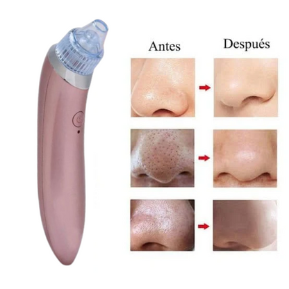 Kit de Limpieza Facil: Extractor de Puntos Negros, Espinillas y Grasa Facial + Juego de herramientas de acero inoxidable